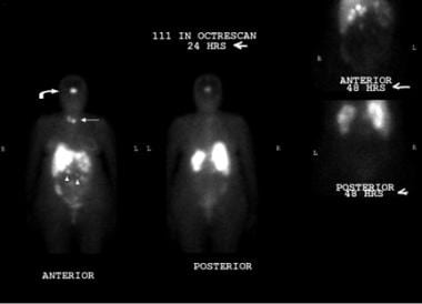 Multiple endocrine neoplasia type 1 (MEN1). Indium