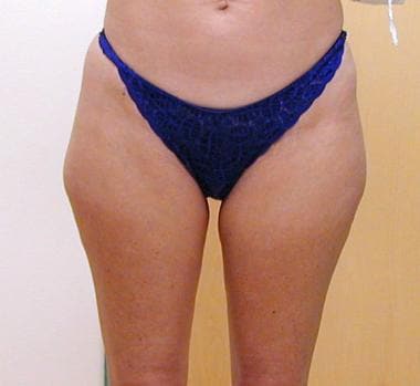 Liposuction, trunk. Frontal view of patient before