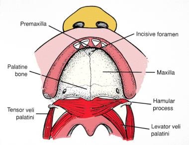 Cleft Palate Repair: Practice Essentials, History of the Procedure, Problem
