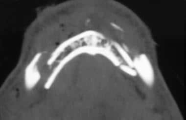 Axial CT scan demonstrating severe displacement. 