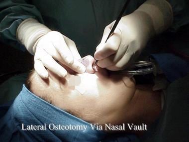 Lateral osteotomy via piriform aperture. 