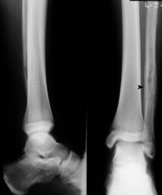 Osteomyelitis