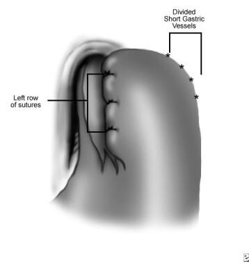 fundoplicatura de Dor, izquierda fila de suturas (después div