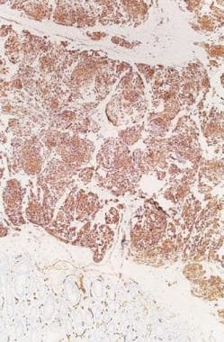 CD-34 stain showing a tumor (medium power). CD-34 