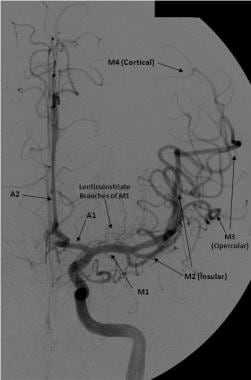 Frontal view of a cerebral angiogram with selectiv