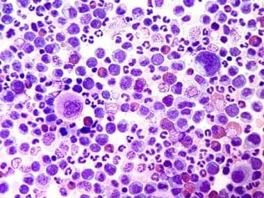 chronic myelogenous leukemia