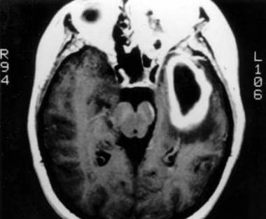 MRI of a brain abscess. 