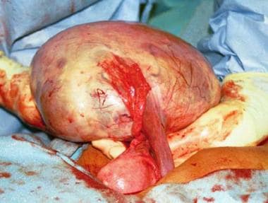 A multilocular right ovarian cyst that is 24 cm in