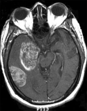 A T1-weighted axial MRI with intravenous contrast 