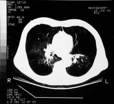 Emphysema. A computed tomograph scan showing sever