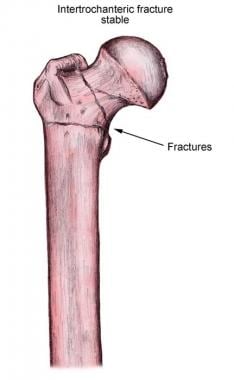 Stable intertrochanteric fracture of the femur. 