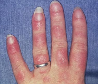 lupus rash on hands