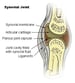 Gonococcal Arthritis Workup: Approach Considerations, Arthrocentesis ...