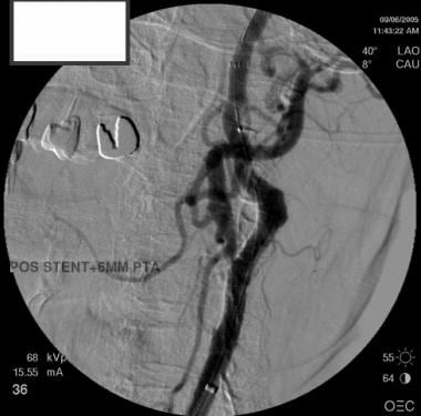 Angioplasty after stent placement; again, note fil
