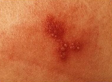 Cutaneous vesicles characteristic of herpes simple
