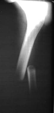 Anteroposterior radiograph of a femoral-shaft frac