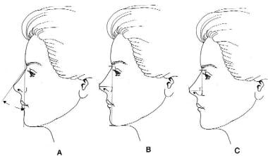 Short Nose Rhinoplasty: History of the Procedure, Problem, Etiology