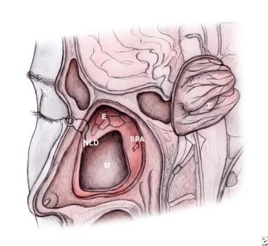 nasal papilloma treatment