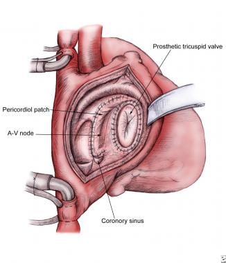 Surgical replacement of the tricuspid valve using 