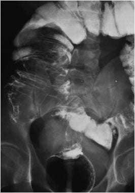 Pediatric Small Bowel Obstruction. A barium enema 