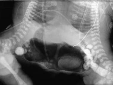 Conjoined twins unified at the thorax and abdomen.
