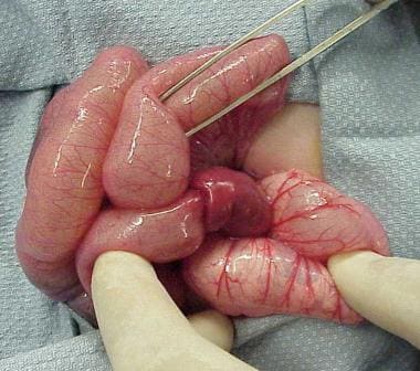 intussusception in children