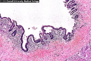 Histologic section of bowel mucosa showing regener