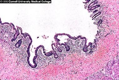 necrotizing enterocolitis histology