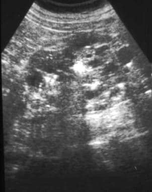 Sonogram shows cysts with bilaterally enlarged kid