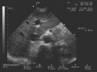 Ultrasound image of transverse inferior vena cava 