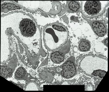 Kidney biopsy from a 7-year-old child with acute p