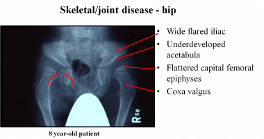 Clinical picture of hip deformity in an 8-year-old