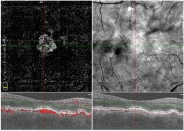 Optical coherence tomography (OCT) shows an active