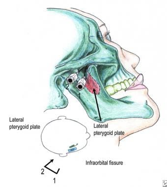 Anatomy of maxillary block. See text for details. 