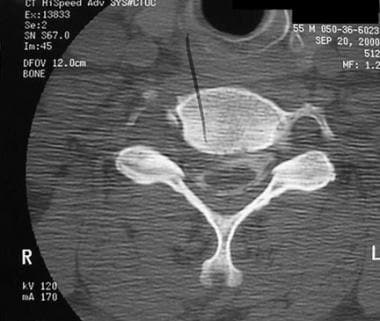 颈椎骨髓浆膜的轴向CT扫描