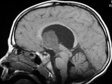 Sagittal midline T1-weighted sequence shows a larg