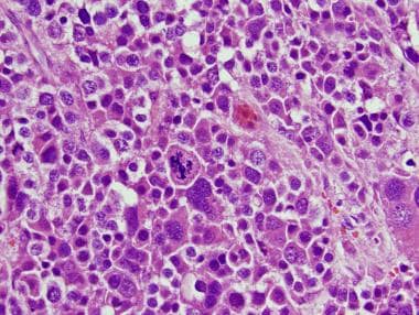 Spermatocytic Tumor Pathology. In this field, one 