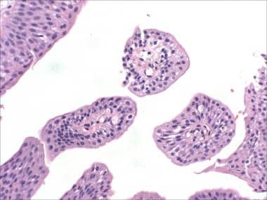 Transitional papilloma bladder