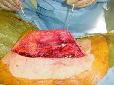 Expanded flap prior to closure of soft tissue defe