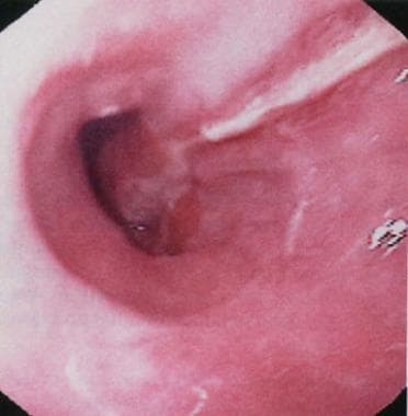 Mallory-Weiss tear. Typical longitudinal mucosal t