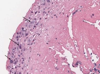 bacterial endocarditis histology