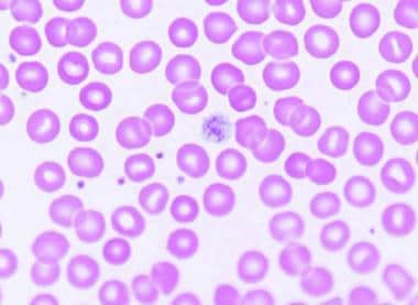 idiopathic thrombocytopenic purpura smear