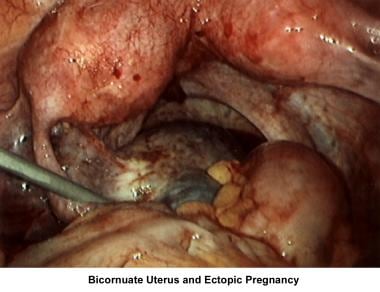 Infertility. Bicornuate uterus and ectopic pregnan