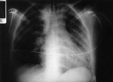 患者的胸部射线照片有吹伏pneu