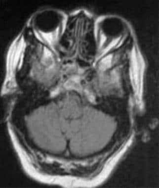 Abnormal flow void in the left cavernous sinus reg