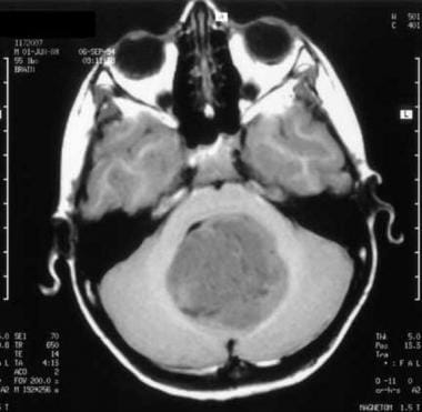 Medulloblastoma. Axial T1-weighted image shows a h