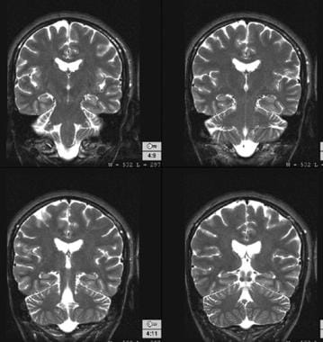 Normal findings on T2-weighted magnetic resonance 