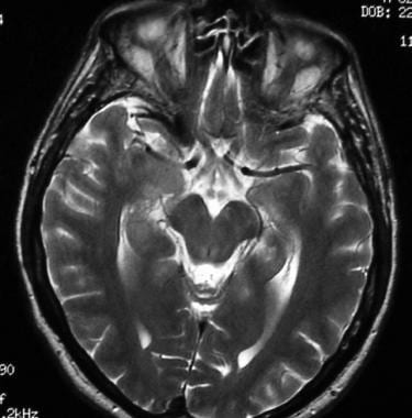 T2-weighted axial MRI shows a normal optic chiasm 