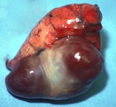 Gross anatomy of a large pulmonary arteriovenous m