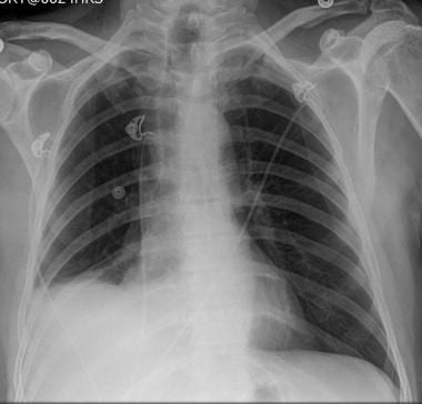 Chest radiograph in a 55-year-old patient with ren